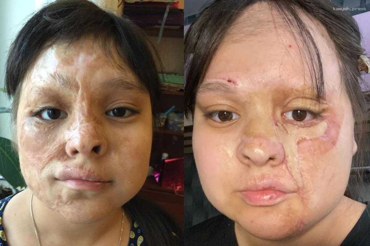 Хирурги смогли восстановить обожженное лицо девочки