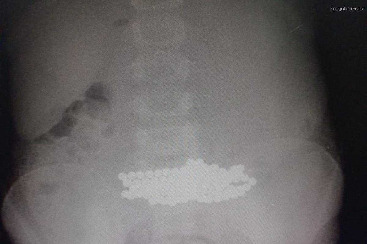 Врачи Ленобласти спасли ребенка, проглотившего более ста магнитов