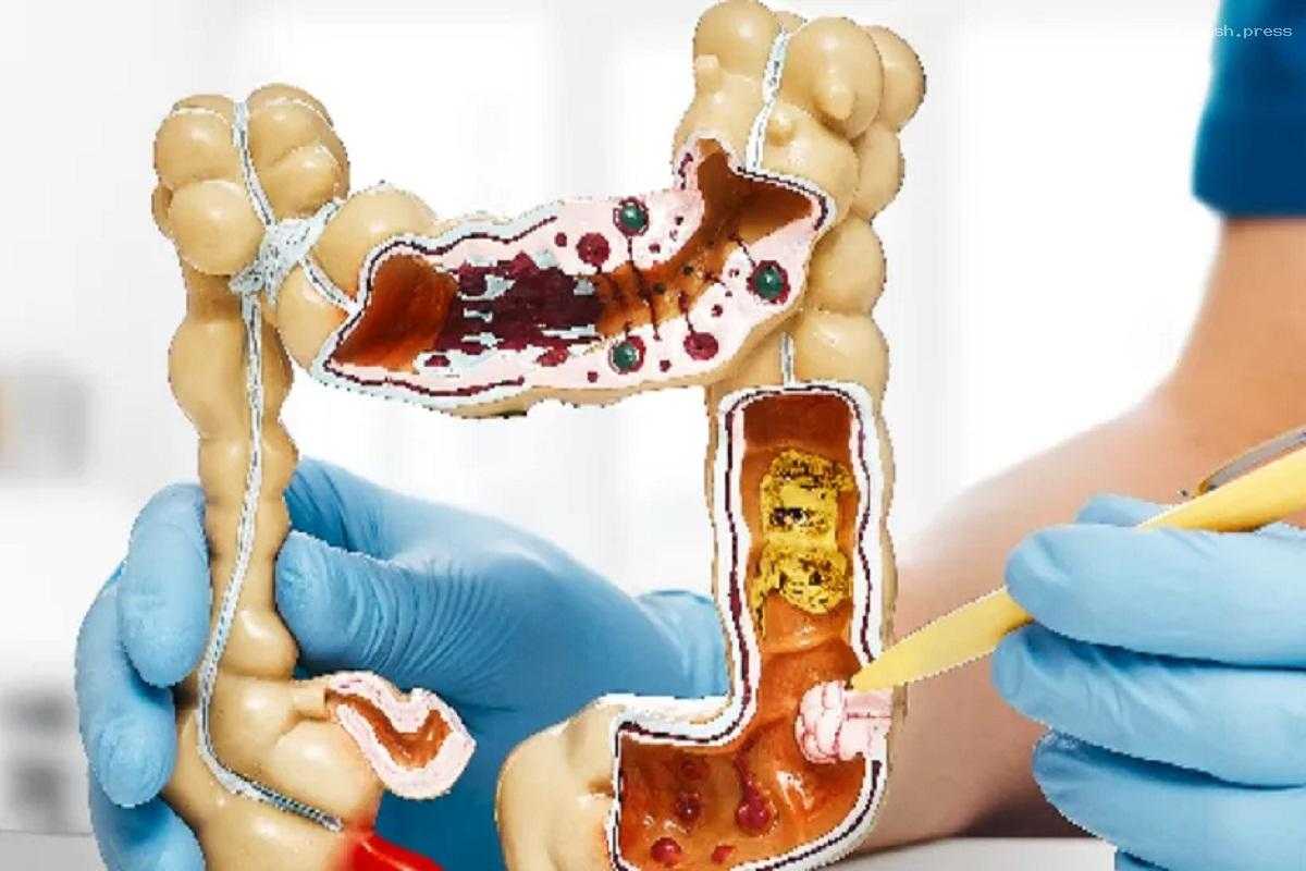 Онкохирург Иванов рассказал о методах профилактики рака кишечника