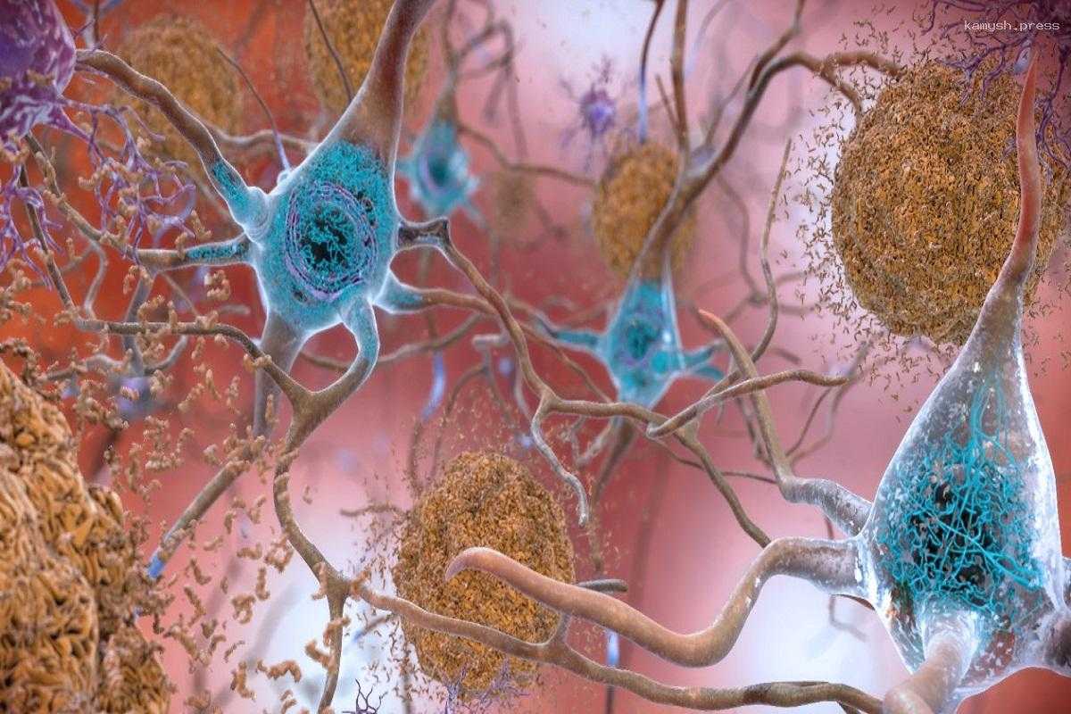 Ученые нашли новый способ предотвращения развития болезни Альцгеймера