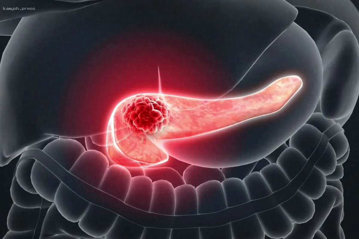 Ученые из Великобритании и США приблизились к излечению рака поджелудочной железы