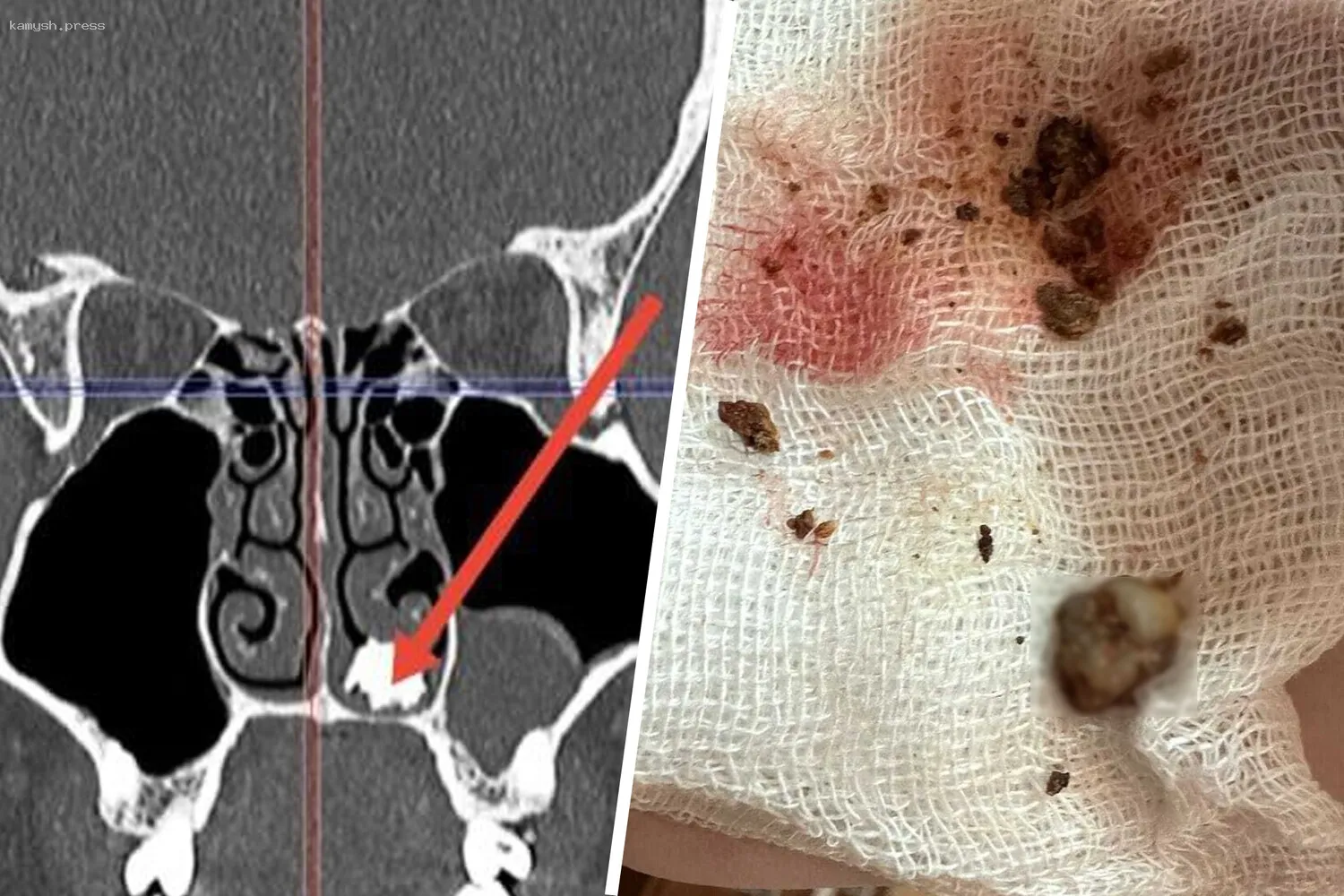Необычная находка в носу россиянина