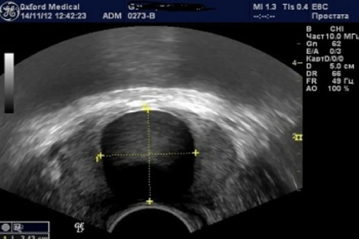 В НСО увеличилось количество случаев рака простаты