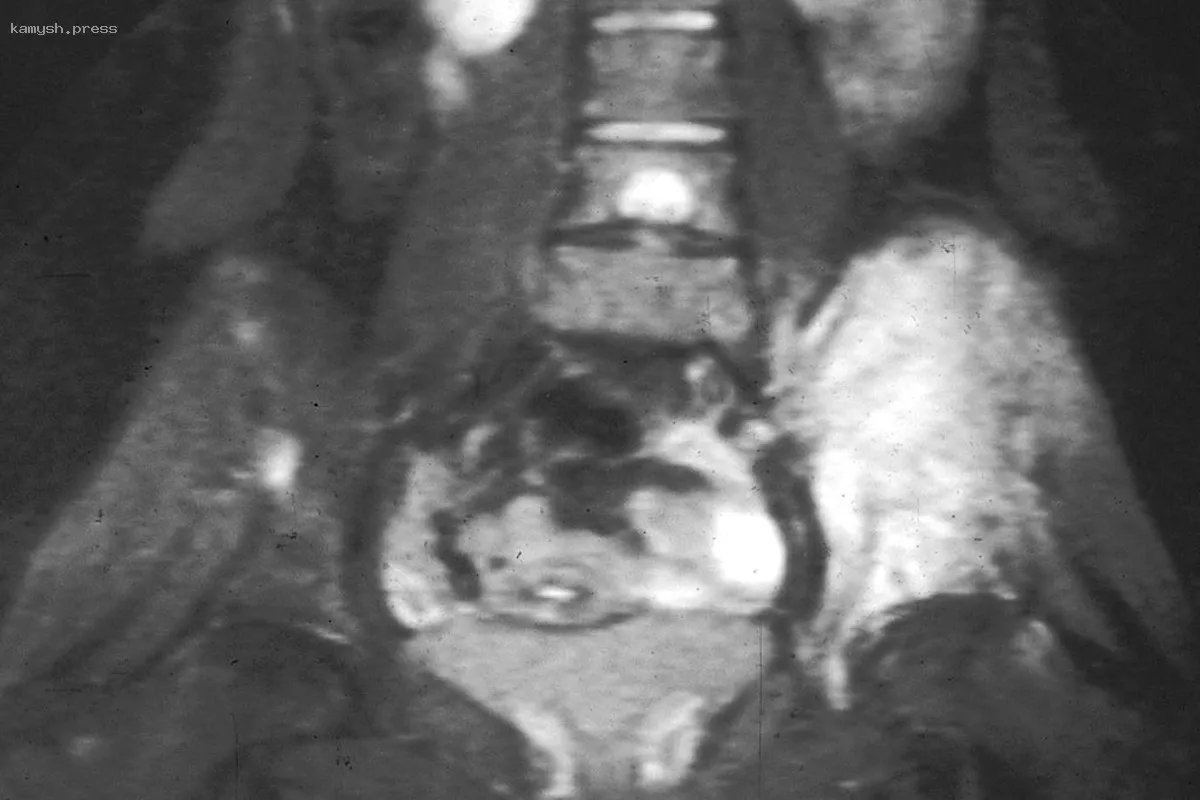 Британский IT-эксперт скончался из-за редкого рака костей