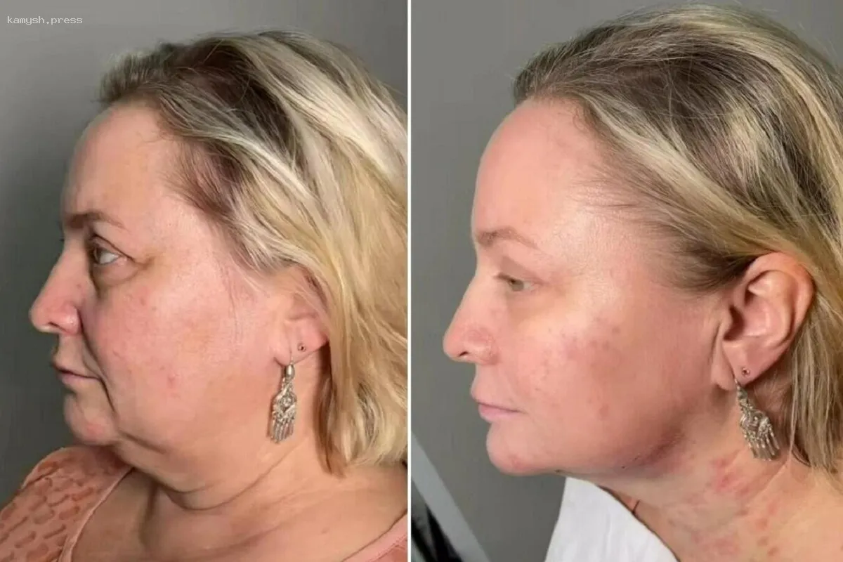 Естественный результат: Светлана Пермякова продемонстрировала эффект от пластической операции