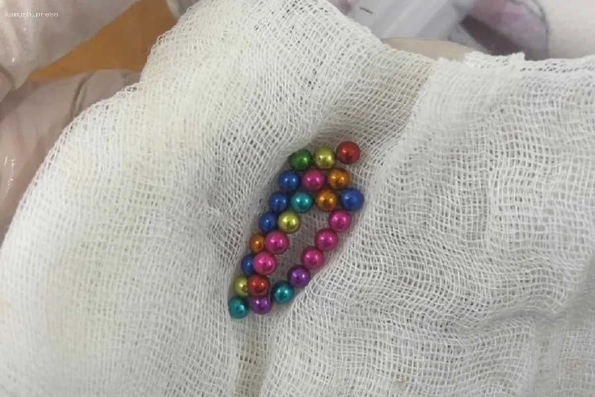 Врачи Томской области вытащили 34 магнита из желудка семилетнего ребенка