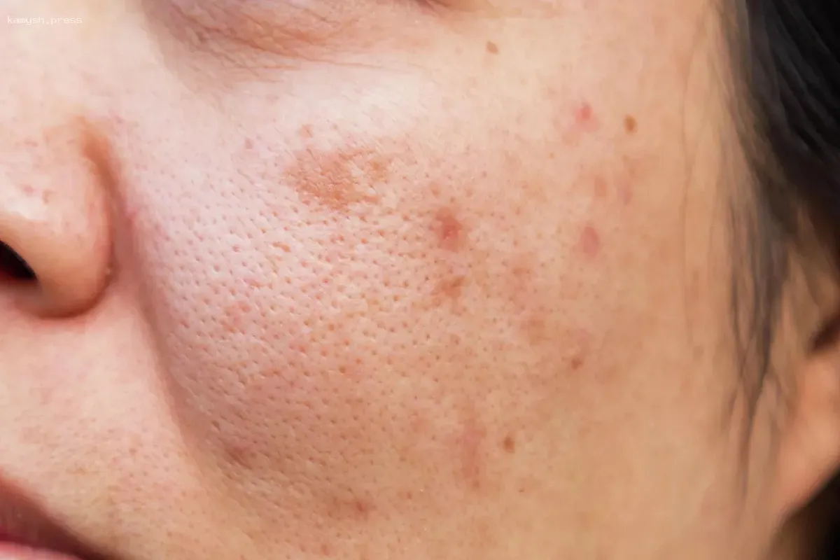 Дерматолог Гуреева предупредила о начале сезона «солнечной крапивницы» в России