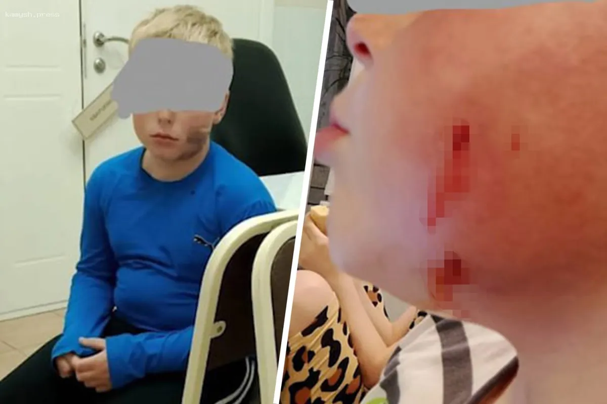 В Омске бродячая собака укусила ребенка в лицо