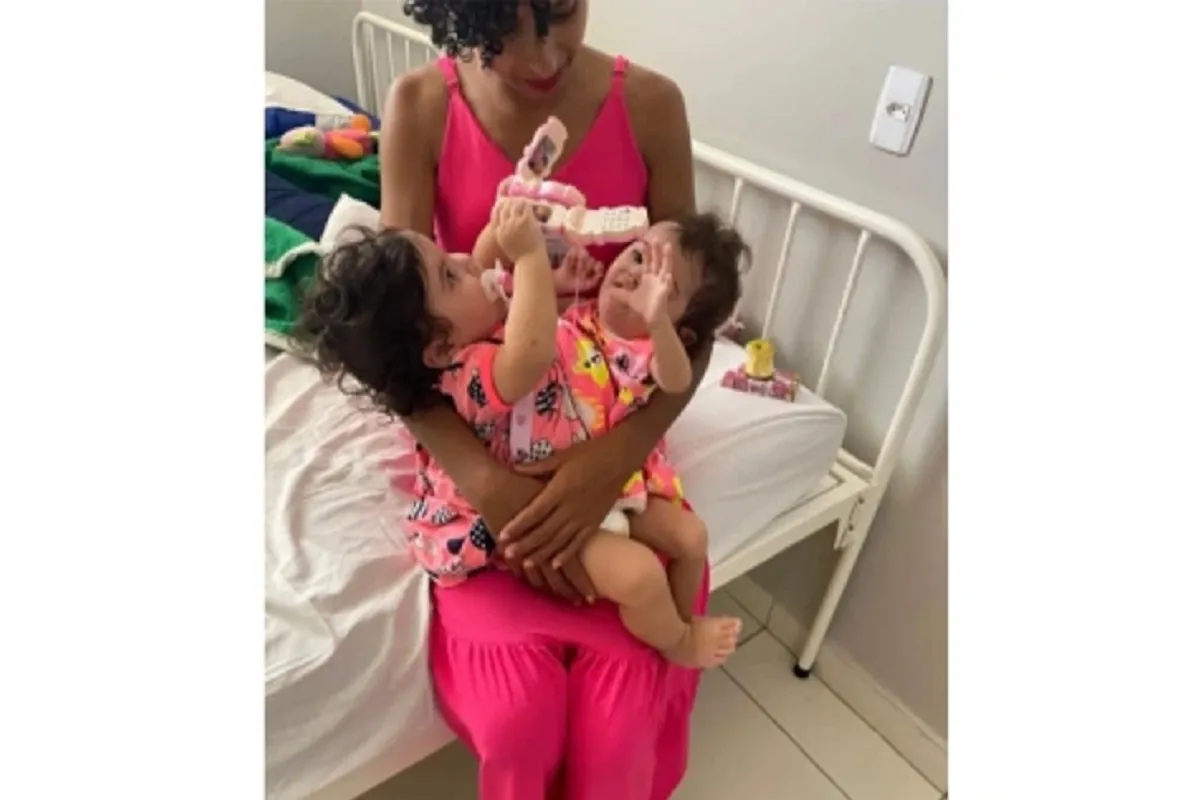 В Бразилии успешно разделили сиамских близнецов, сросшихся в грудной области