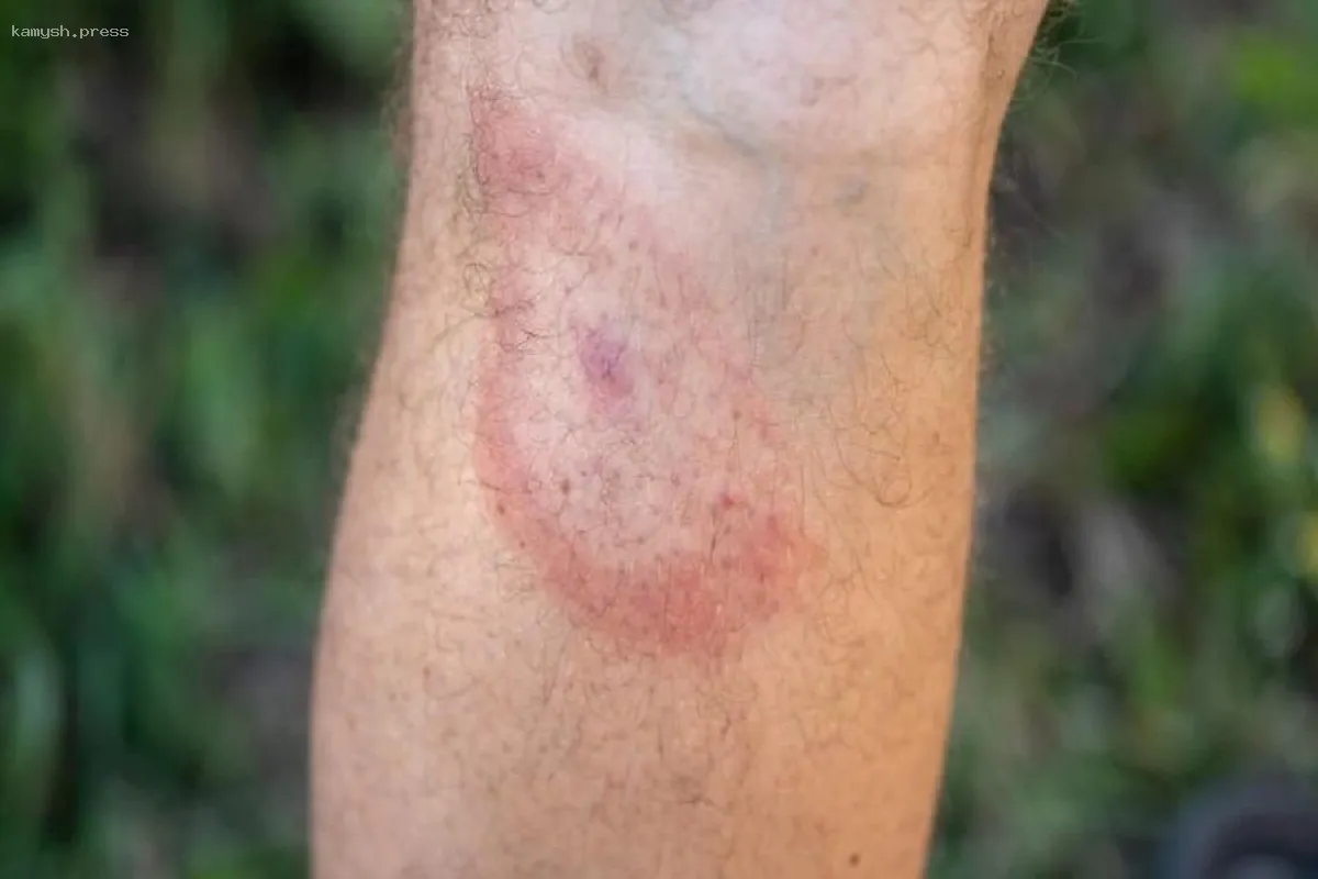 Специалист по инфекционным болезням Коновалов: В майские праздники возрастает угроза заражения боррелиозом