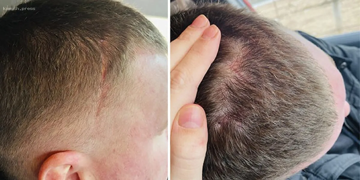 В Пушкинской городской больнице челюстно-лицевые хирурги использовали современный метод лечения во время операции